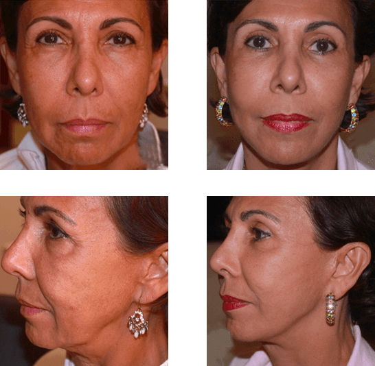 Lifting bas du visage lifting doux et lift pommette