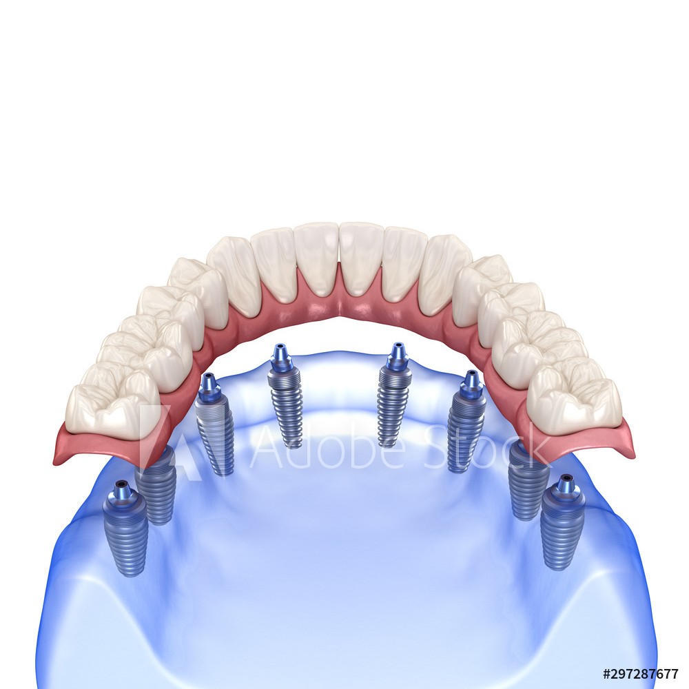 Bar Attachment Denture » Minneapolis Oral Surgeons » Minnesota Oral