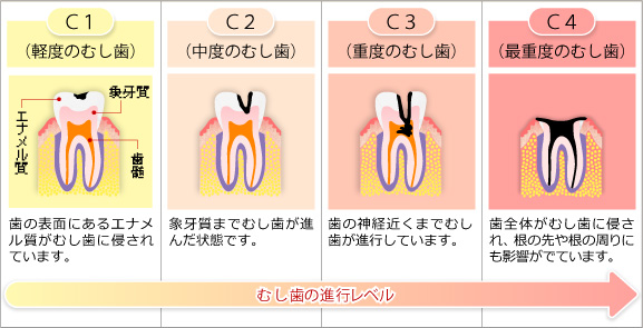 【虫歯治療】詰め物・被せ物の種類を保険適用・自由診療別でご紹介します 浦和もちまる歯科・矯正歯科クリニック