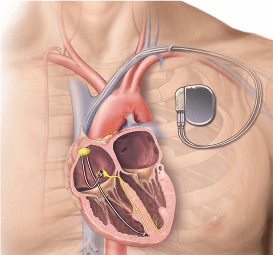 How Do Pacemakers Work? Modern Heart and Vascular
