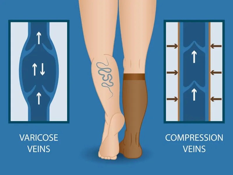 Venous Insufficiency and The Main Causes