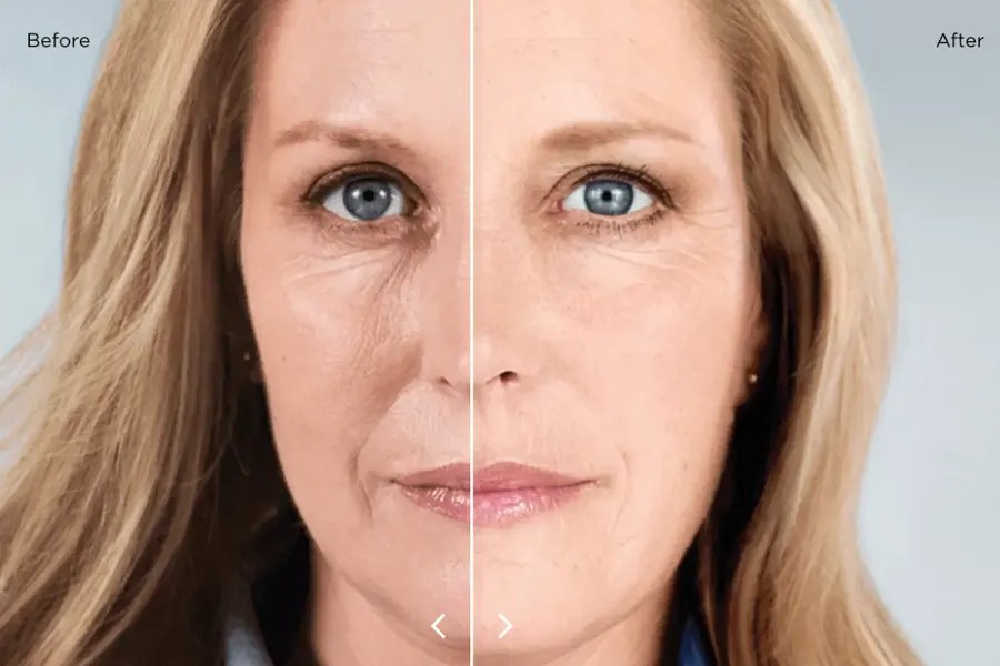 Your Youthful Transformation with Sculptra Modesto Aesthetics CA