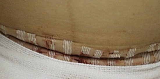 Csection Scar 1 year later