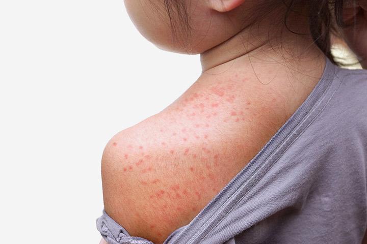 Heat Rash Symptoms Heat Rash How Long Does Prickly Heat Take To Go