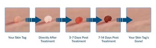 Claritag Easily Remove Skin Tags At Home & Skip The Cost of a Doctor! Giveaway Mommies with
