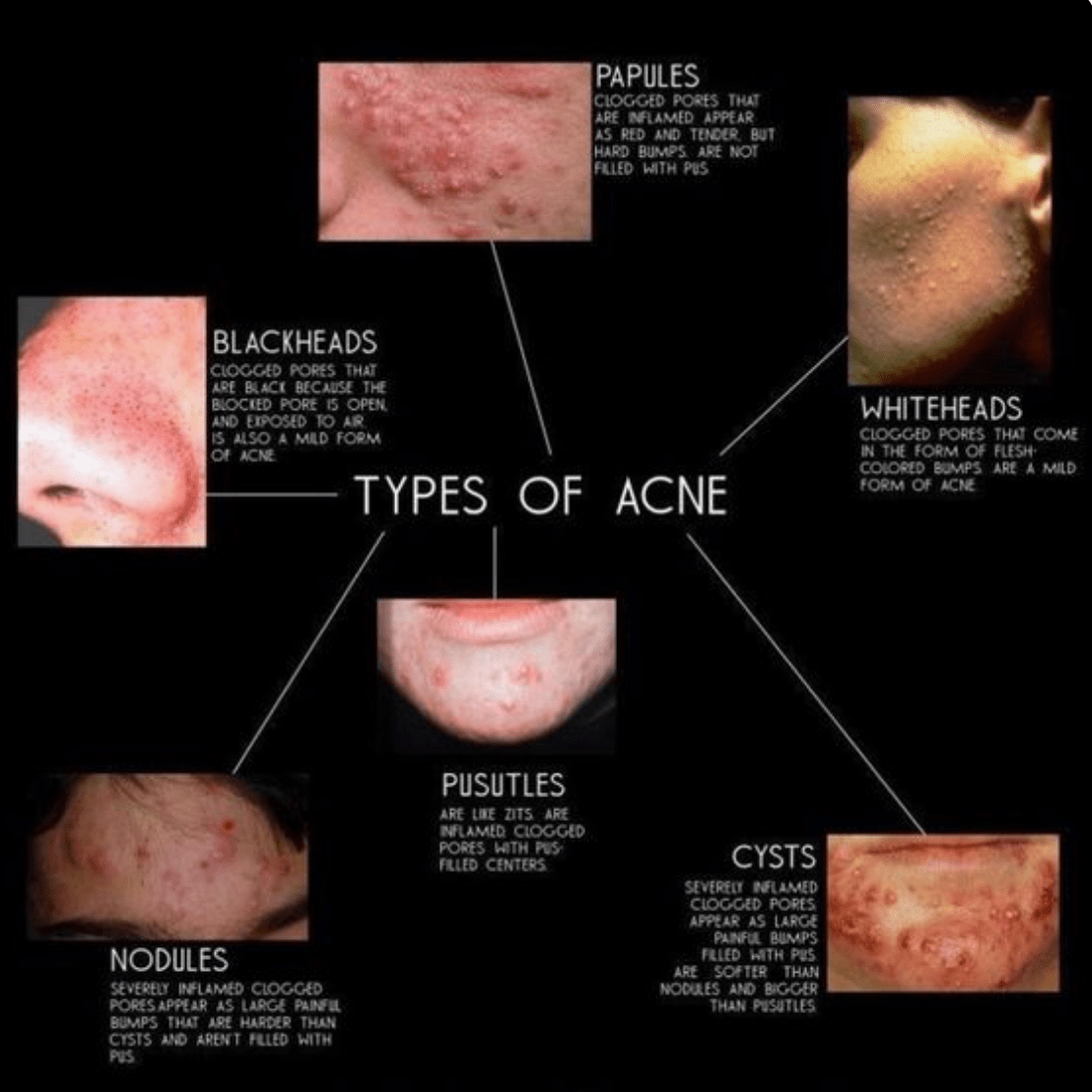 Acne From Beauty to SelfConfidence Moore Road Medi Spa