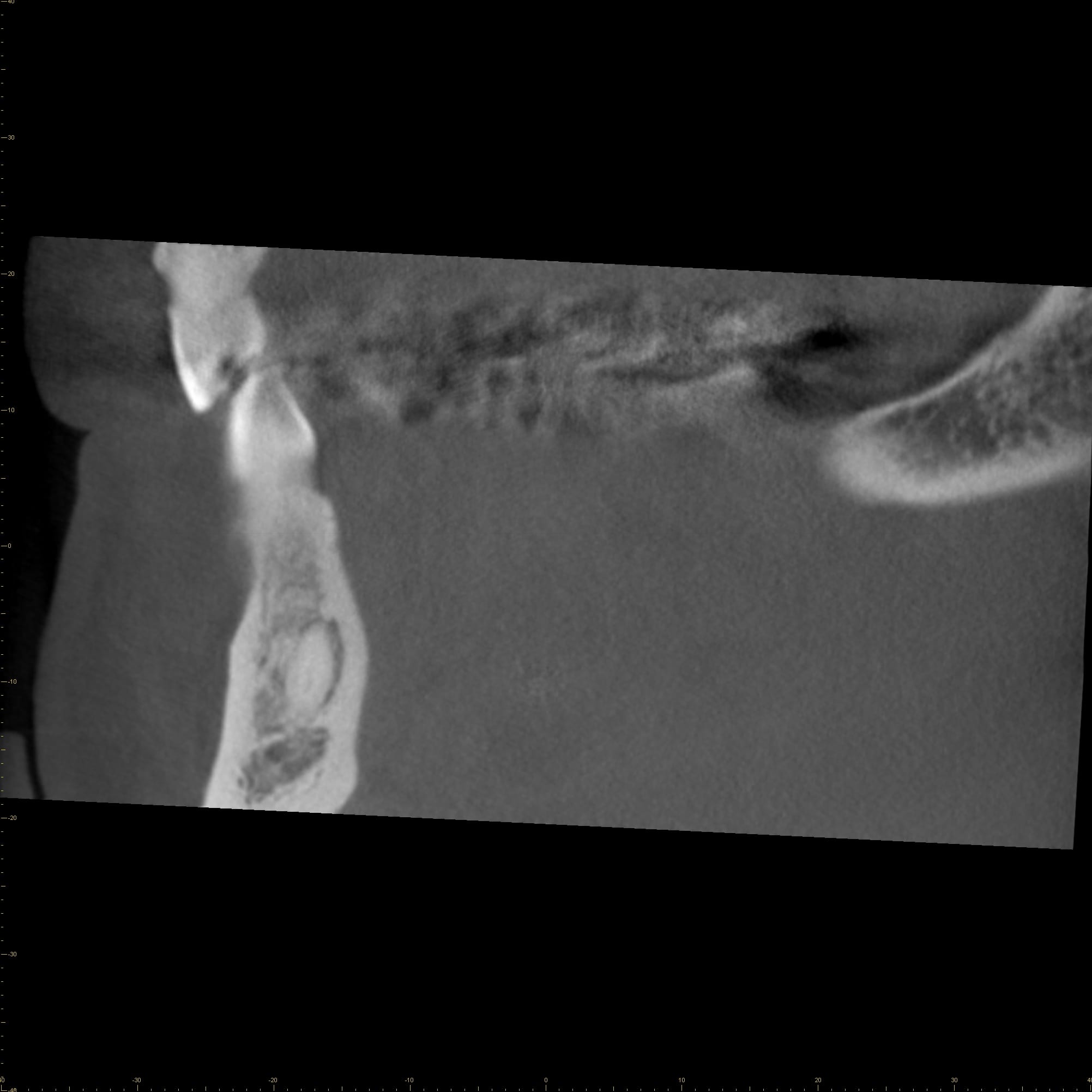 Extended edentulous space with two missing premolars in the posterior