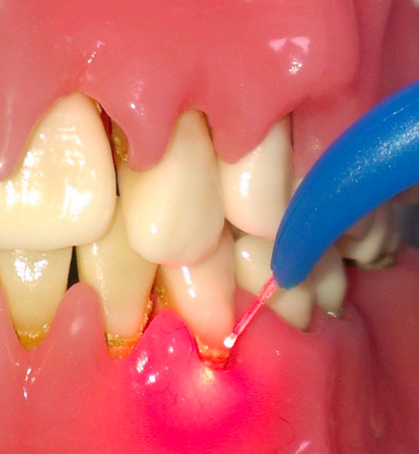 Laser Gum Therapy Lee's Summit MO Periodontal Lasers