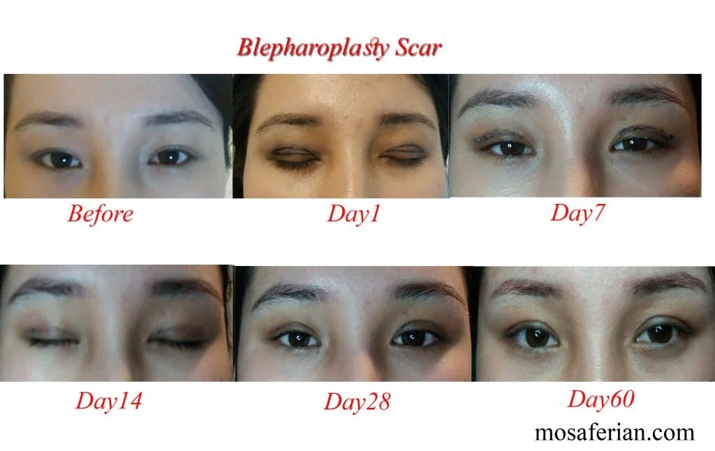 two week upper eyelid surgery recovery day by day Archives