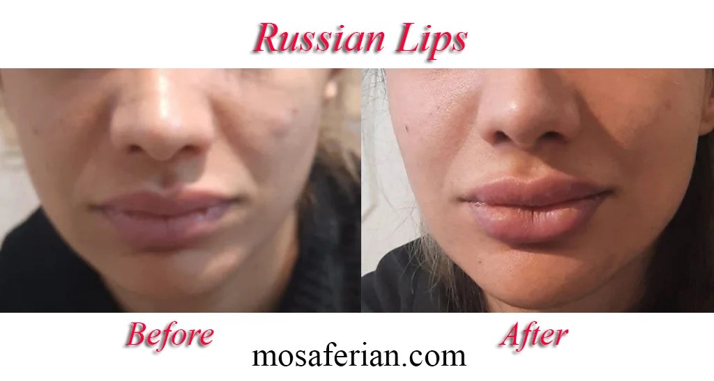 russian lip filler