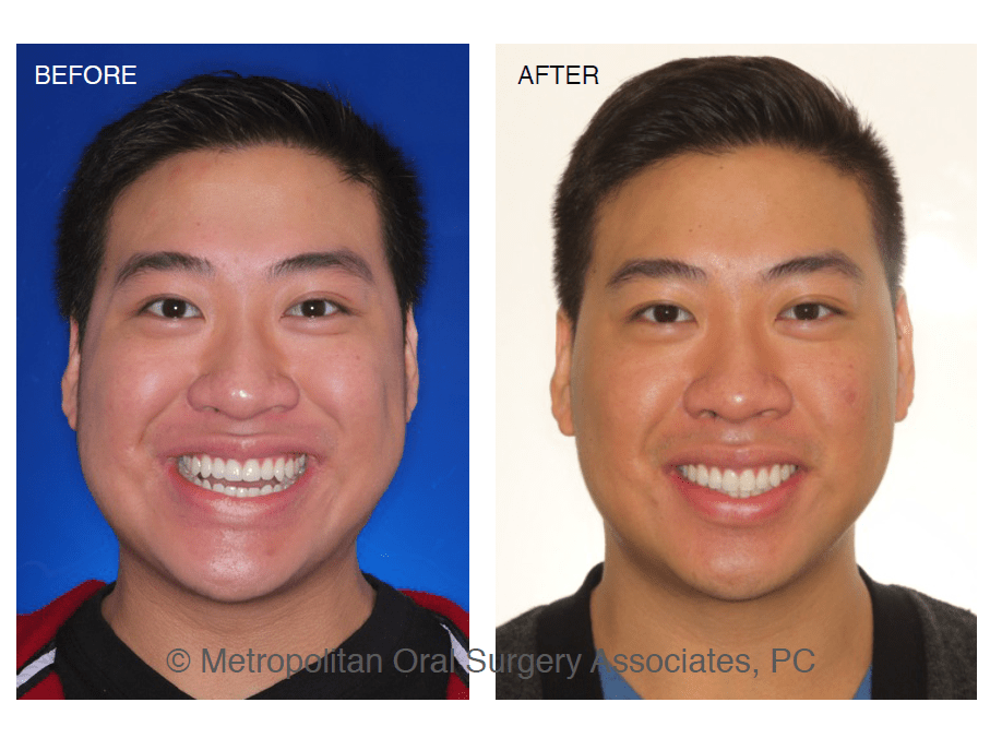 Jaw Surgery New York NY, Metropolitan Oral Surgery Associates, P.C.