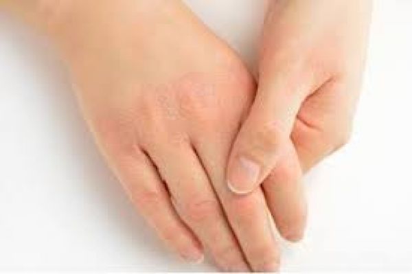 الاكزيما الدهنية