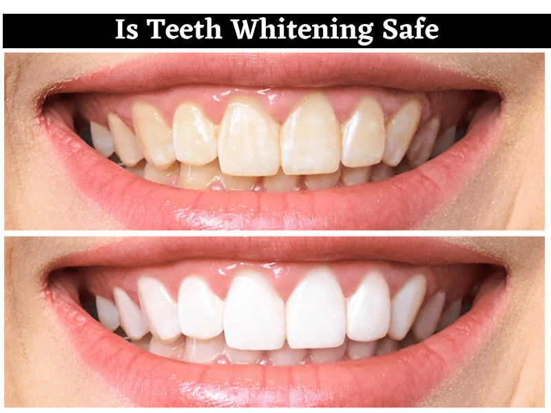 Is Teeth Whitening Safe? Understanding the Pros, Cons, and Alternatives