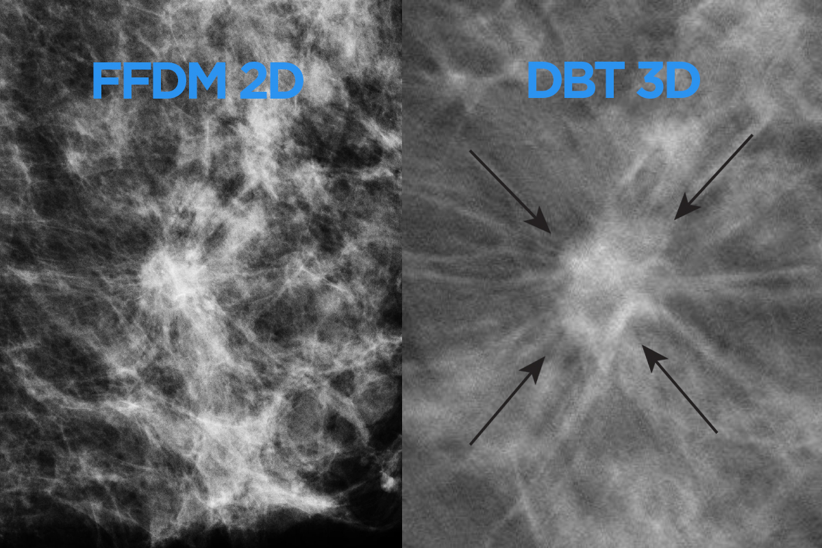 Erwin Insurance Hershey Pa Is 3d Mammogram Covered By Insurance