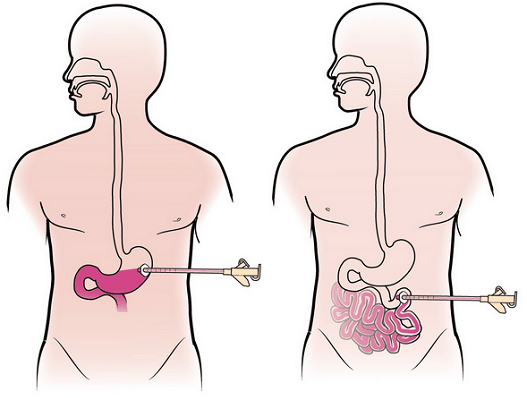About the Placement of Your Percutaneous Endoscopic Gastrostomy (PEG) or Jejunostomy (PEJ) for