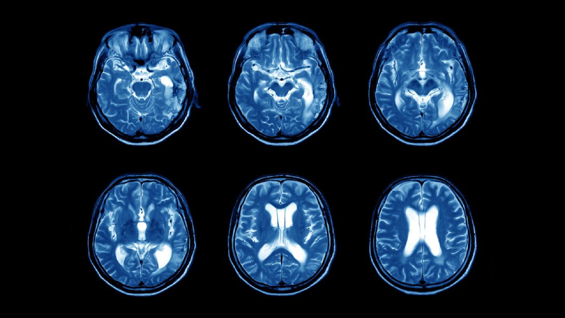 A new way to use MRI to more accurately diagnose MS MS Society