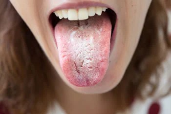 Lingua Spaccata Lingua Fissurata Cos E Cause E Disturbi Associati