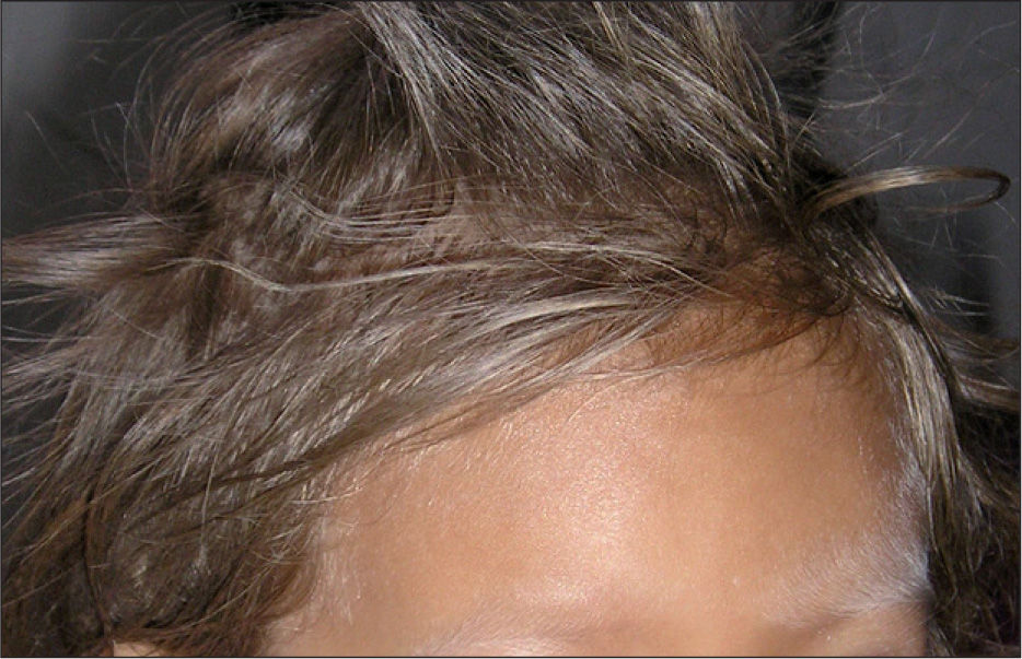 Griscelli syndrome MyBioSource Learning Center Griscelli syndrome MyBioSource Learning Center