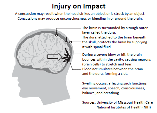Sports Concussion Facts and Symptoms MyBrainTest