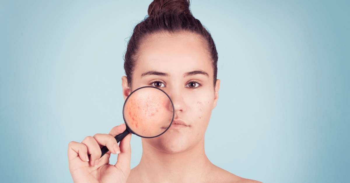 How to Treat Fungal Acne MyDCSI