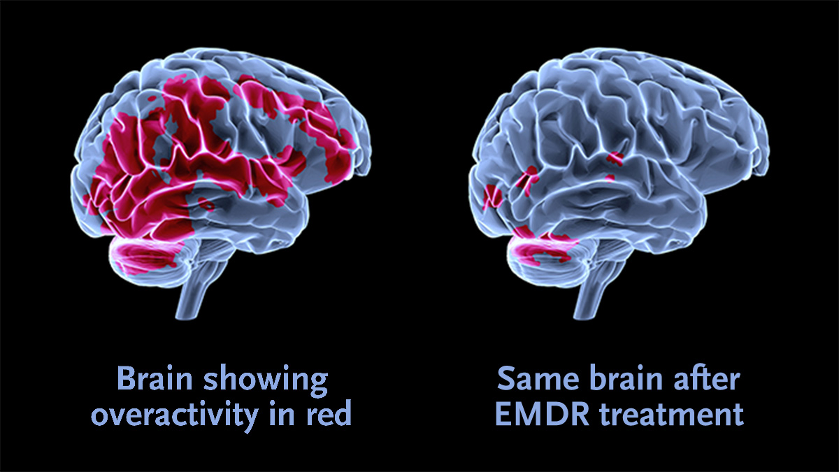 What is EMDR Therapy? | The Deeper Journey