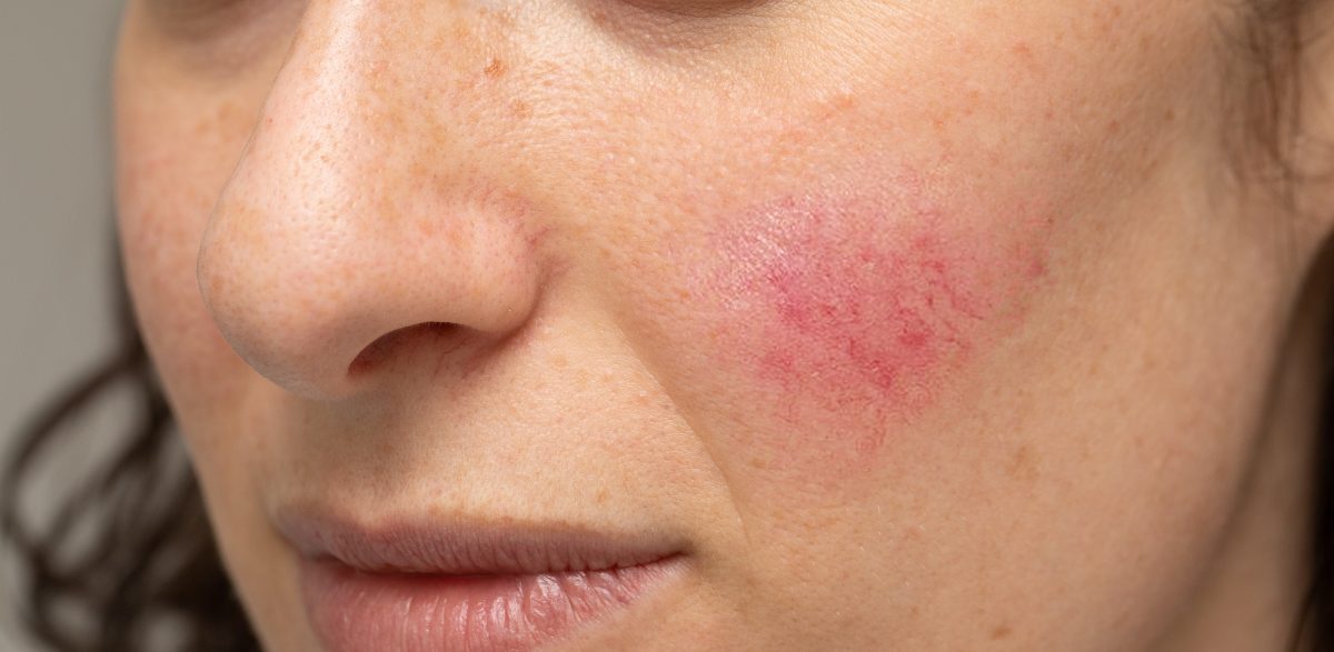 Rosacea: Symptoms, Causes And Treatment