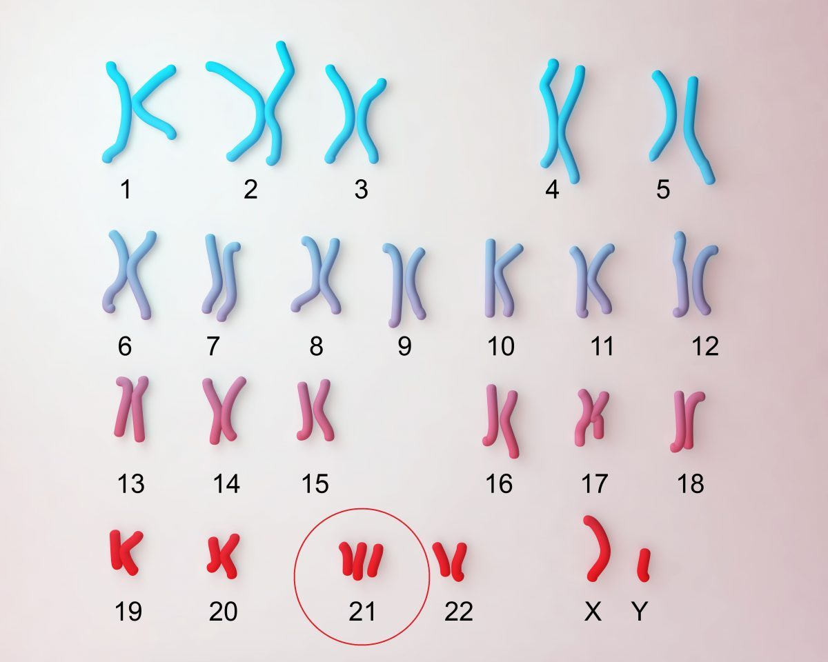 Trisomy 21 Down Syndrome Down Syndrome (Trisomy 21) A child with