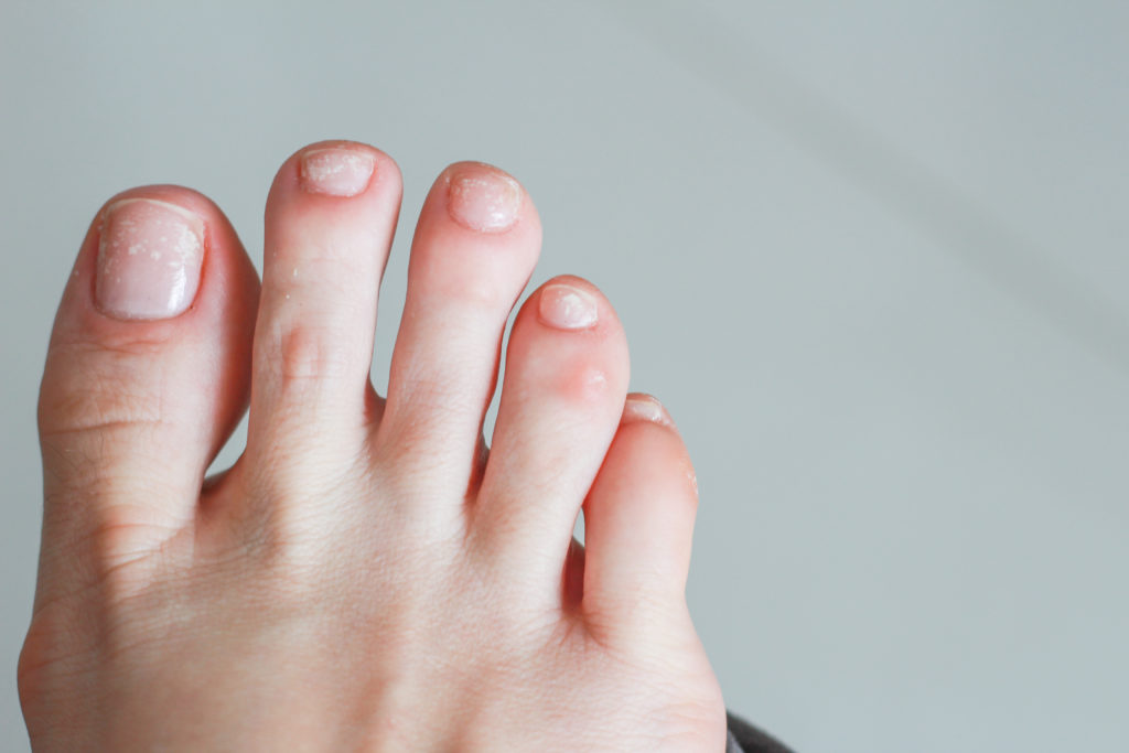 Causes Of White Spots On Your Toenails – My Footdr