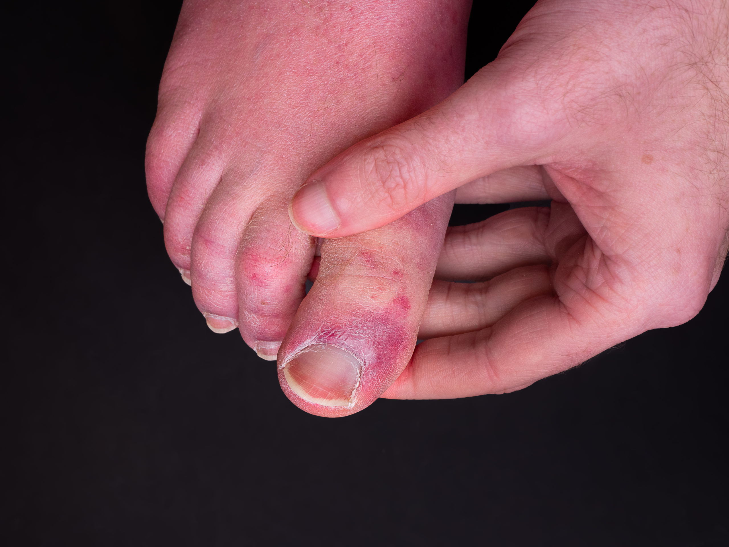 How Do You Get Rid Of Dark Spots On The Toes? – My Footdr