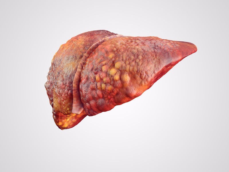 Liver Disease / Hepatic Disease From the initial symptoms to liver