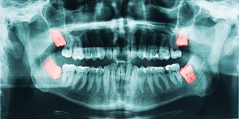 Wisdom Teeth Removal / Impacted Tooth Extraction The procedure explained