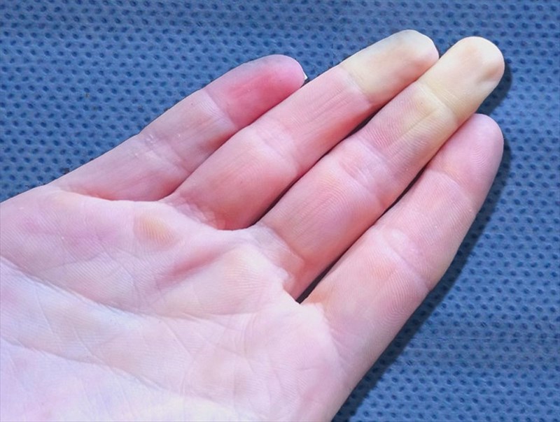 Causes, symptoms, diagnosis and treatment of Raynaud phenomenon