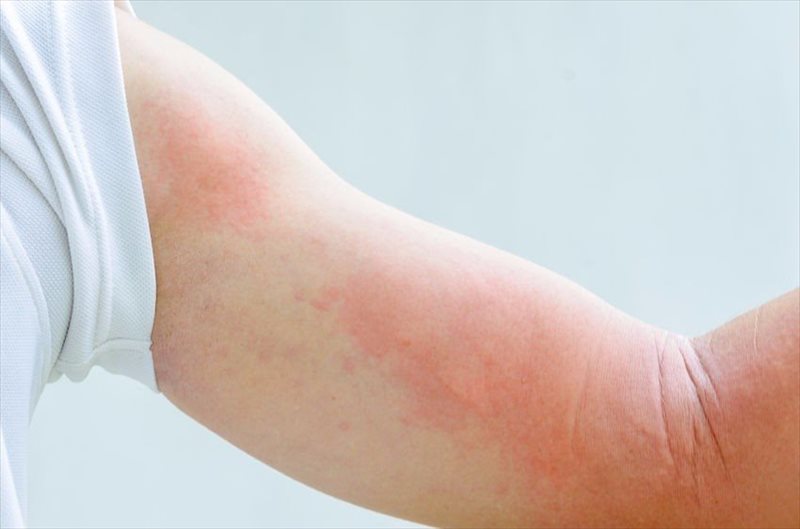 Signs and symptoms of scarlet fever