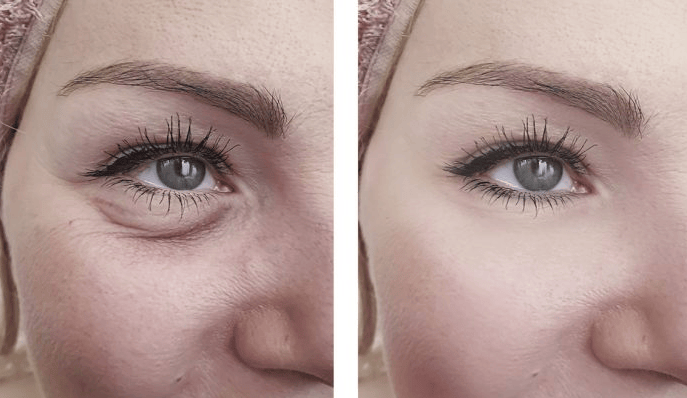 10 Best Clinics for Eye Bag Removal in Philippines [2021 Prices]