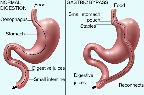 10 Best Clinics For Gastric Bypass Surgery In Czech Republic [2022 Prices]