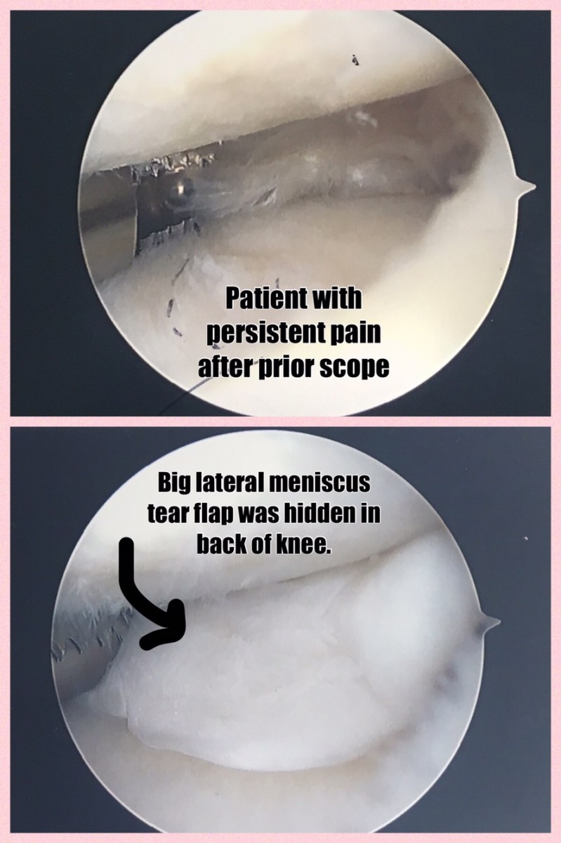 Persistent Knee Pain after Knee Arthroscopy