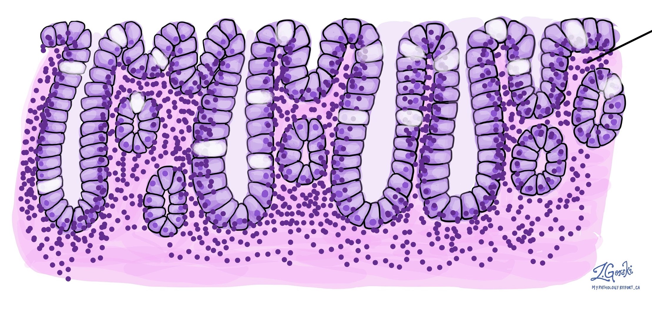 MyPathologyReport.ca Pathology for patients.