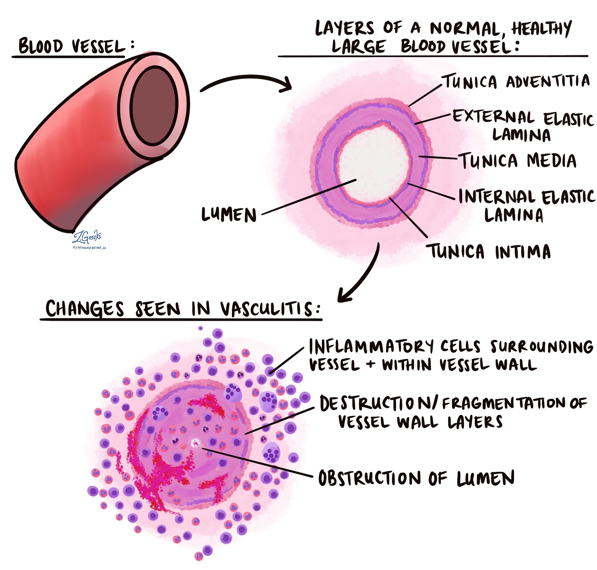 Vasculitis MyPathologyReport.ca