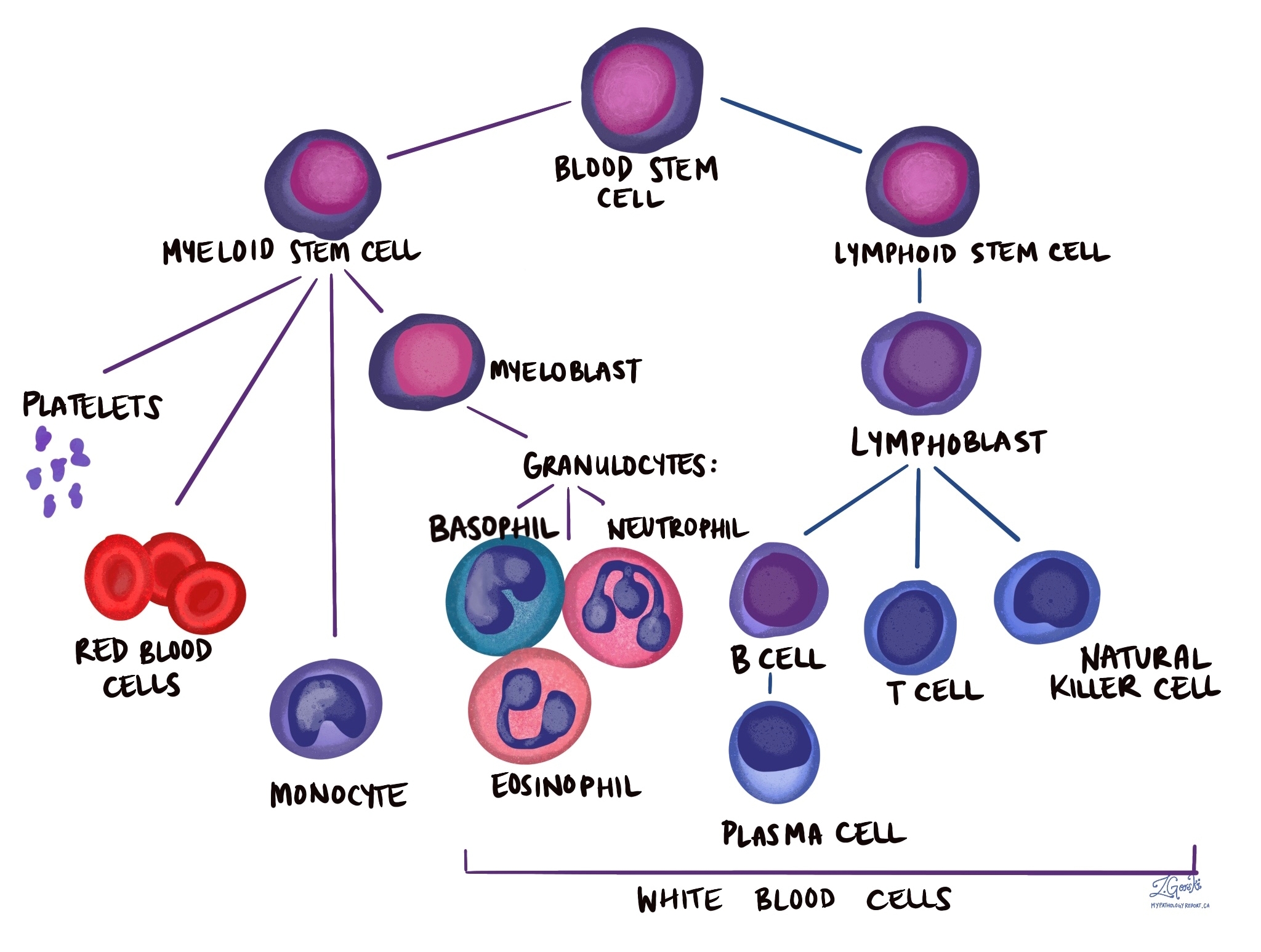 Acute myeloid leukemia (AML) MyPathologyReport.ca