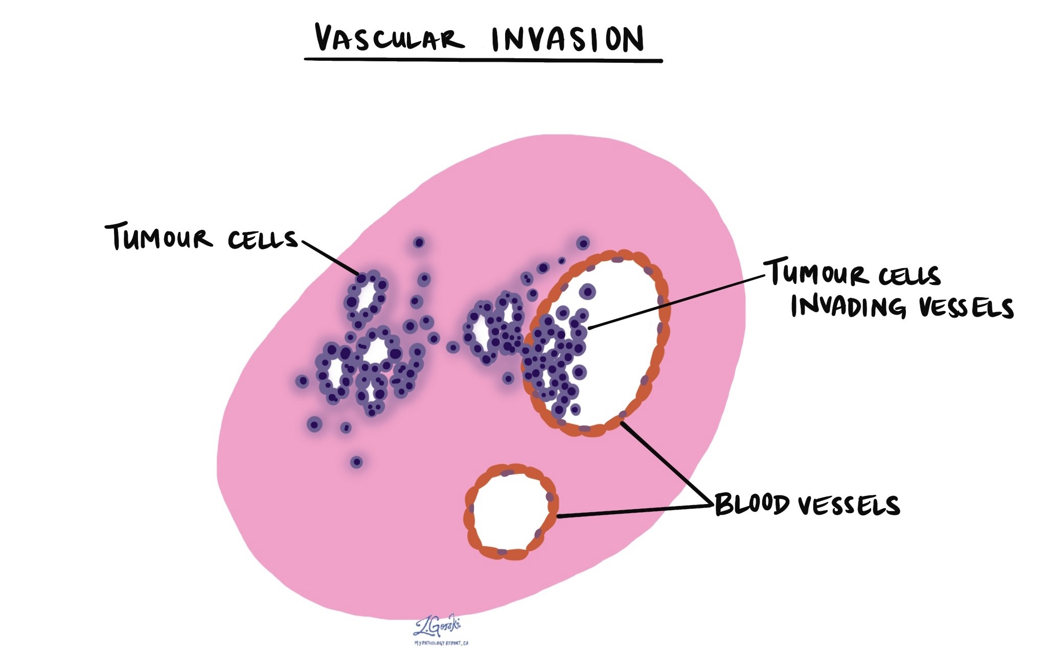 Invasion vasculaire MonRapportPathologie.ca