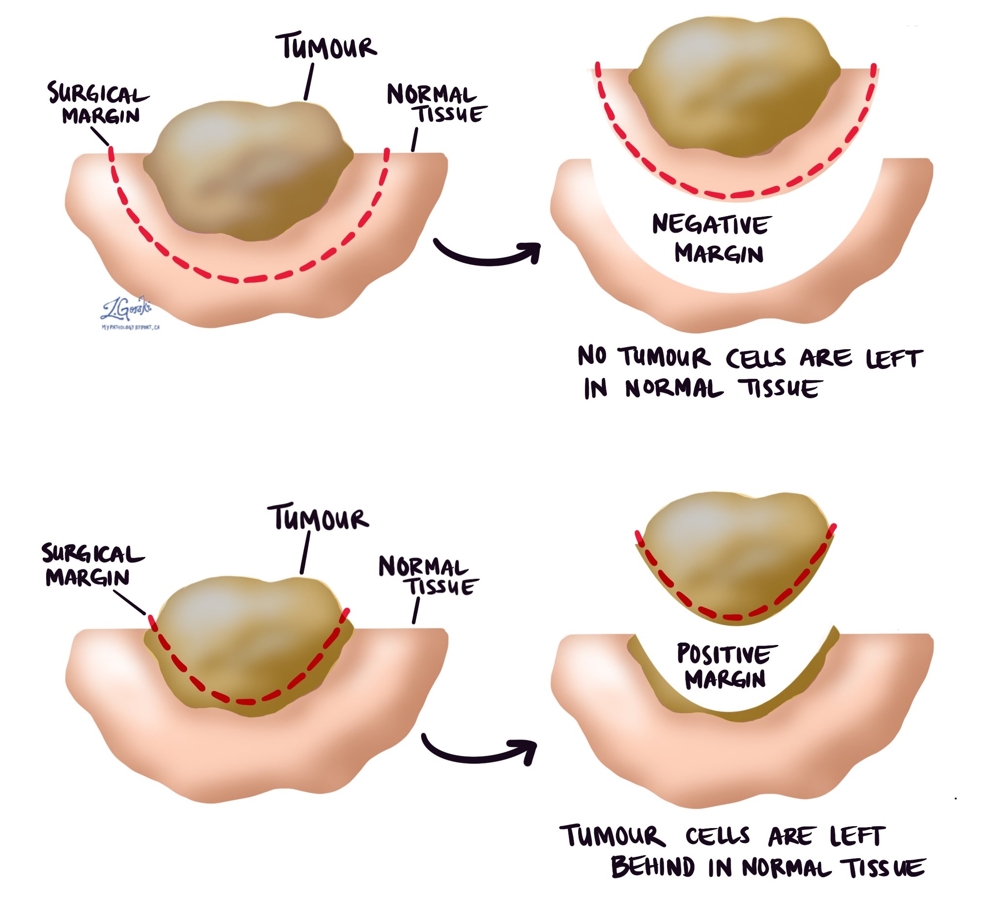 Sinonasalis angiofibroma MyPathologyReport.ca