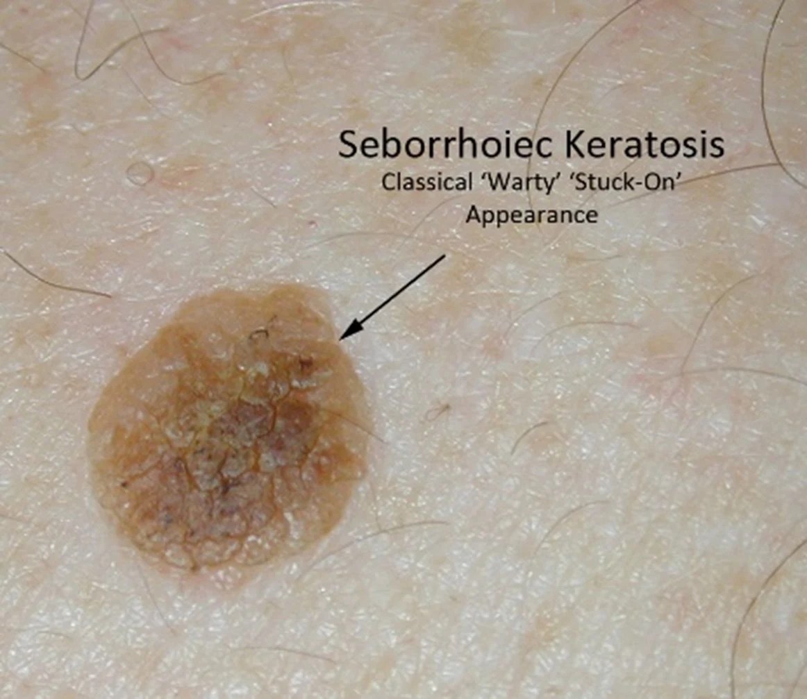 Inflamed Seborrheic Keratosis