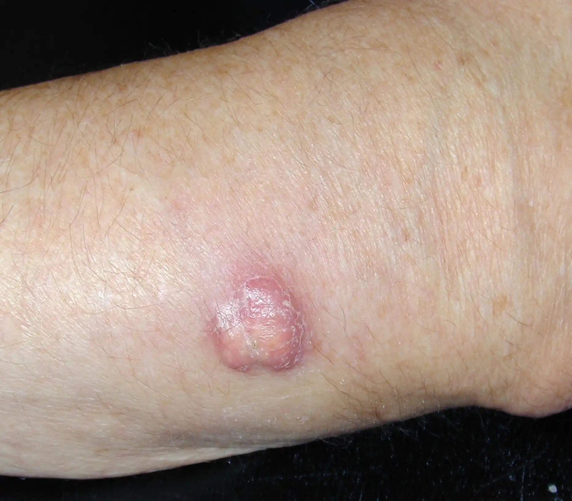 Squamous cell carcinoma MySkinDoctor