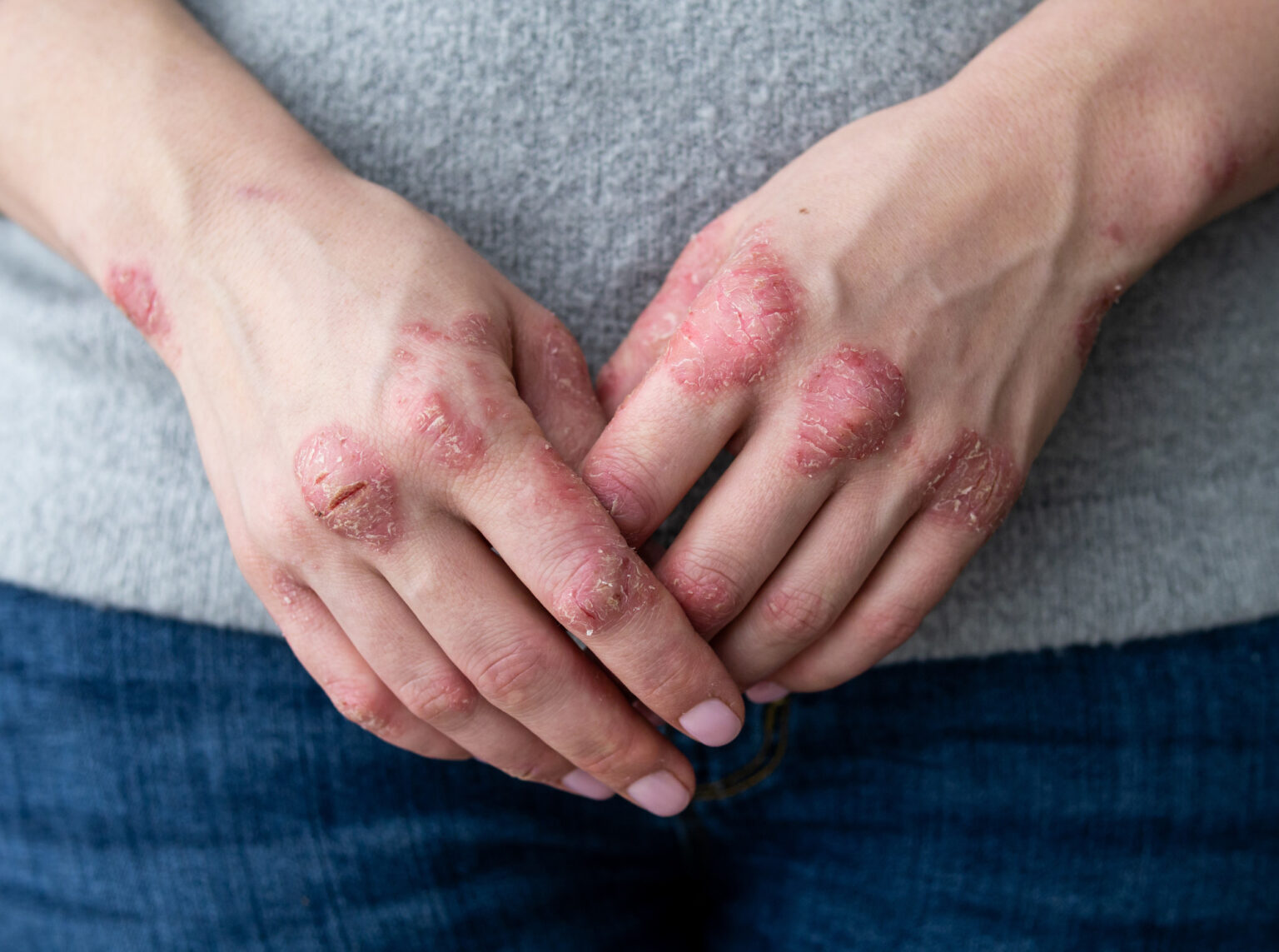 Is Inverse Psoriasis Natural Treatment Right For Me?