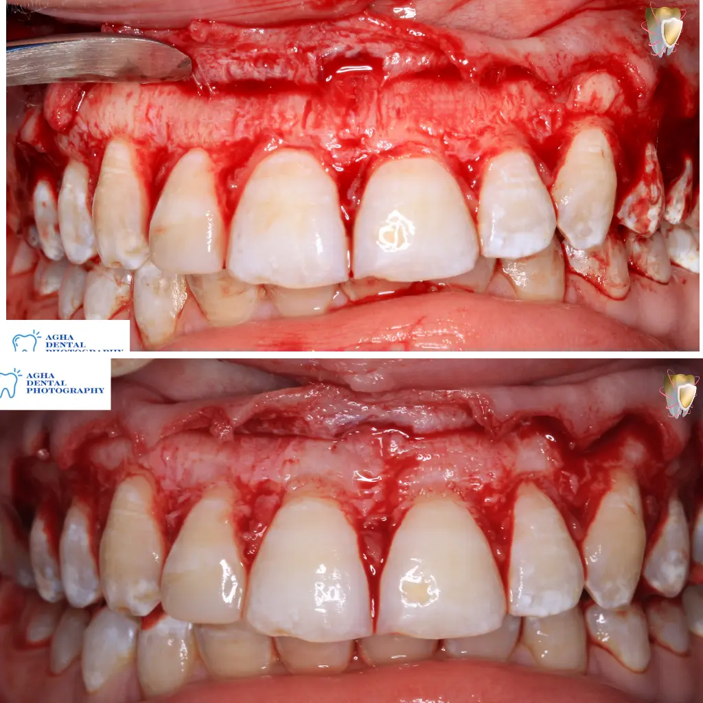 Esthetic crown lengthening surgery for correction of gummy smile of