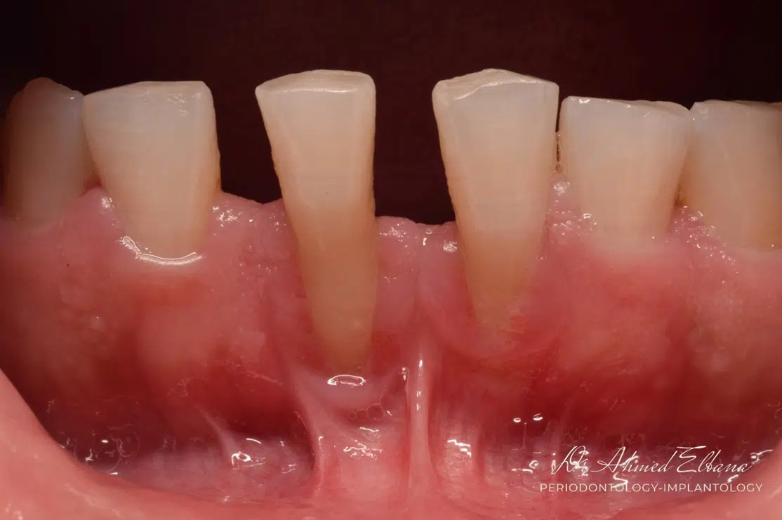 Gingival Recession Treatment FGG MyZerodonto