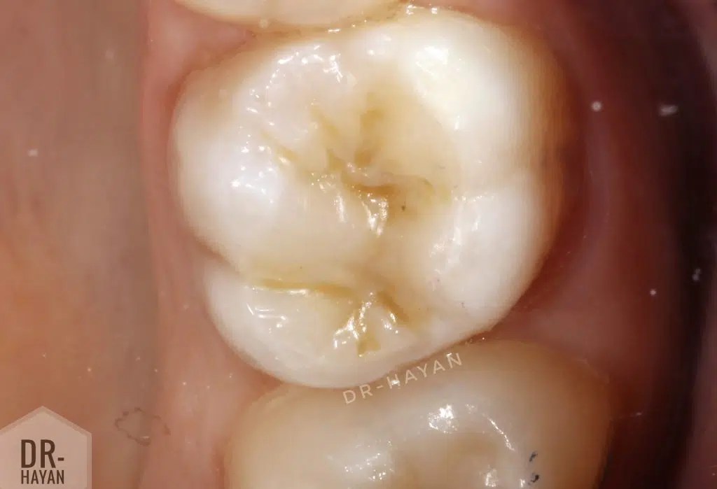 An extended occlusal pit And ,How can you manage post operative