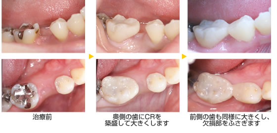 保険 奥歯 ブリッジ Hoken Nays.