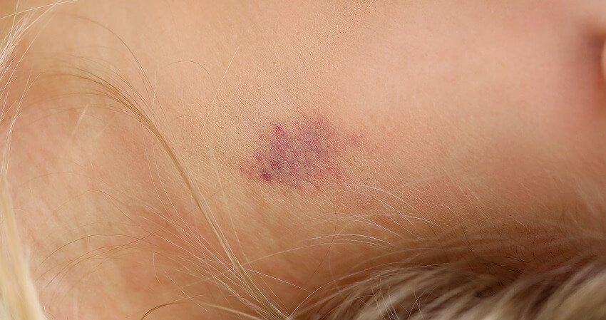 How to Get Rid of a Hickey in a Day [5 Easy Ways] 2020