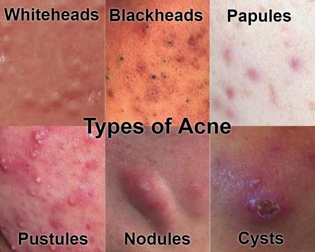 Acne • Repair & Rejuvenate Acne Skin • NASCENT Skin Clinic